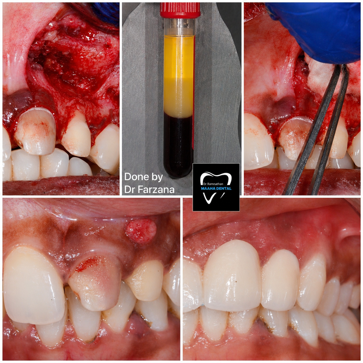 Periapical Surgery